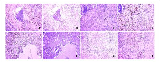 Figure 2. The representative reciprocal relationships between HPV16 or HPV18 E6 and p53 immunostainings in serial paraffin sections of lung tumors. A and B, C and D, E and F, and G and H, two serial sections from the same lung tumors. A, p53 immunostaining–positive; B, HPV16 E6 immunostaining–negative. C, p53 immunostaining–negative; D, HPV16 E6 immunostaining–positive. E, p53 immunostaining–positive; F, HPV18 E6 immunostaining–negative. G, p53 immunostaining–negative; H, HPV18 E6 immunostaining–positive.