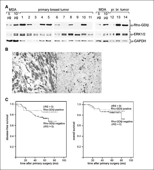 Figure 6. A, Rho-GDIβ protein is expressed in ∼40% of breast cancer specimen tested. Western blot analysis of proteins isolated from representative fresh-frozen breast cancer samples. B, immunohistochemical analysis of a paraffin section of a Rho-GDIβ–positive (left) and of a Rho-GDIβ–negative (right) invasive breast cancer specimen by using a Rho-GDIβ–specific antibody. C, the outcome of breast cancer patients is independent of the Rho-GDIβ protein level in the tumor cells. Kaplan-Meier curves for disease-free and overall survival for 117 patients with invasive breast cancer expressing Rho-GDIβ protein at either detectable level (IRS > 0, Rho-GDIβ positive) or undetectable level (IRS = 0, Rho-GDIβ negative) as determined by immunohistochemistry. The log-rank test P values for Rho-GDIβ–positive breast tumors compared with the Rho-GDIβ–negative breast tumors were 0.149 for disease-free survival and 0.534 for overall survival.