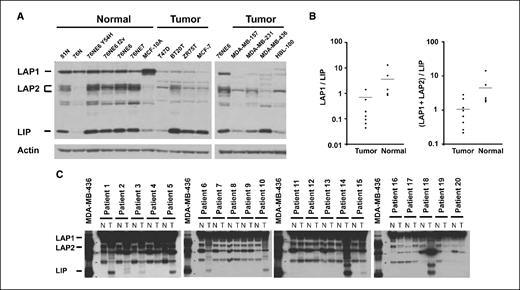 Figure 1. Characterization of mammary epithelial cells for C/EBPβ. A, exponentially growing cells were subjected to Western blot analysis using 50 μg of protein for each cell line. The protein extract was loaded onto a 10% SDS-PAGE gel, electrophoresed, and transferred to a nitrocellulose membrane. A rabbit polyclonal antibody to C/EBPβ (C-19, Santa Cruz Biotechnology) was used as the primary antibody. The bands corresponding to LAP1 (55 kDa), LAP2 (45 kDa), and LIP (20 kDa) are indicated. Actin was employed to normalize the amount of each C/EBPβ isoform in each lane. B, the expression levels of each isoform were densitometrically quantified by IPLab Gel Quantitation Software. The ratios of LAP1/LIP and (LAP1 + LAP2)/LIP in normal cells versus tumor cells are plotted in the scatter diagram. C, whole-cell lysates were extracted either from normal breast epithelial tissue (N) or from tumor tissue (T) in 20 patients with breast cancer. Each lane contained 50 μg of protein extract and was incubated with C/EBPβ antibody.
