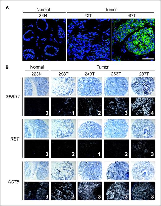 Figure 1. Expression of GFRα1 and RET in human breast tumors. A, cryosections of one normal human breast (sample 34N) and two ER+ invasive ductal carcinomas (42T and 67T) were labeled with anti-GFRα1 antibody followed by Alexa 488 antirabbit immunoglobulin (green). Nuclei were counterstained with TO-PRO-3 (blue). Scale bar, 50 μm. B, riboprobes for RET, GFRA1, and ACTB (β-actin) were hybridized to sections of a human breast cancer tissue microarray. Representative images of one normal breast section (sample 228N) and four different tumors (samples 298T, 243T, 253T, and 287T) are shown with the score given to each sample indicated. The intensity of signals (white reflective silver grains) was scored from 0 to 4 for GFRA1 mRNA transcripts and from 0 to 3 for RET mRNA transcripts (see Materials and Methods for details of the scoring). For each probe, top panels show Giemsa counterstain; bottom panels show autoradiographic silver. Cores were 0.6 mm in diameter.