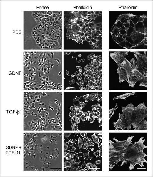 Figure 4. MCF7 cells display scattering in response to GDNF. MCF7 cells plated onto glass coverslips were incubated in DMEM plus 0.5% FCS overnight and then stimulated with 10 ng/mL GDNF, 5 ng/mL TGF-β1, or 10 ng/mL GDNF plus 5 ng/mL TGF-β1 for 48 h. Cells were fixed, permeabilized, and stained with Alexa 555–conjugated phalloidin. Scale bars, 100 μm (left and middle) and 25 μm (right). Images of cells costained with phalloidin and antivinculin antibody are shown in Supplementary Fig. S1.