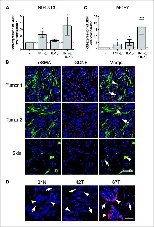 Figure 5. GDNF expression is up-regulated in response to proinflammatory signals. A, qPCR was performed to determined the fold change in Gdnf mRNA expression in NIH-3T3 cells following treatment with 5 ng/mL IL-1β and/or 10 ng/mL TNF-α. Relative expression was determined from a fold difference of 1, which was the value assigned to untreated control (comparator). Columns, mean fold changes in Gdnf mRNA levels from at least seven independent experiments; bars, SE. *, P < 0.05. B, cryosections of two MCF7 tumor xenografts and adjacent mouse skin stained with FITC-conjugated anti-αSMA antibody (green) and anti-GDNF antibody followed by Alexa-555 antigoat immunoglobulin (red). Nuclei were counterstained with TO-PRO-3 (blue). Scale bar, 50 μm. Arrowheads in tumor samples, GDNF expression in αSMA-positive infiltrating fibroblasts; arrows, MCF7 tumor cells. Arrowhead in skin sample, αSMA-positive blood vessel; arrow, GDNF-negative fibroblasts. C, qPCR analysis of MCF7 cells was performed as described in A. Columns, mean fold changes in GDNF mRNA levels from eight independent experiments; bars, SE. *, P < 0.05; ***, P < 0.0001. D, cryosections of normal human breast (34N) and two breast tumor samples (42T and 67T) shown in Fig. 1A were labeled with anti-GDNF antibody followed by Alexa 555 antigoat immunoglobulin (red). Nuclei were counterstained with TO-PRO-3 (blue). Arrowheads in sample 34N, normal myoepithelial and luminal epithelial cells. Arrowheads in samples 42T and 67T, tumor cells. Arrows, stromal cells. Scale bar, 50 μm.
