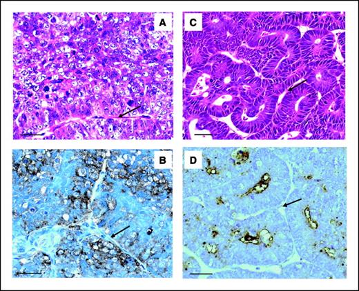 Figure 1. Sections of LS174T and SW1222 colorectal xenografts. A and C, histologic appearance (H&E) of LS174T showing a poorly differentiated tumor with heterogeneous distribution of blood vessels (A), and SW1222 showing a well-differentiated tumor with regular blood vessels around glands (C). B and D, CEA distribution on perivascular tumor cells in LS174T (B) and on the luminal surface of tumor cells in SW1222 (D). Magnification, ×40. Arrows, blood vessels. Bars, 50 μm.