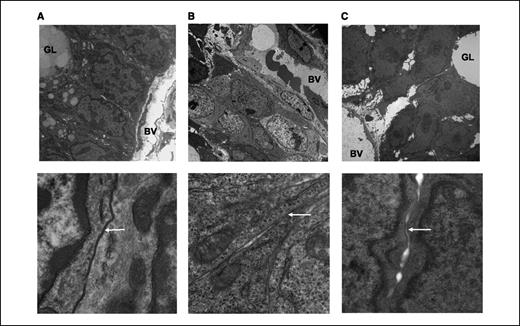 Figure 3. Transmission electron micrographs comparing the structure of normal colon and the colorectal xenografts. A, normal colon showing a regular pattern of epithelial cells lined up along a glandular lumen (top, magnification, ×5,600) and regular gap junctions (bottom, magnification, ×31,000). B, LS174T showing randomly scattered, compact tumor cells (top, magnification, ×4,400) and frequent gap junctions (bottom, magnification, ×31,000). C, SW1222 showing more regular tumor cells with large intercellular spaces (top, ×4,400) and shorter gap junctions (bottom, magnification, ×31,000). BV, blood vessel; GL, glandular lumen; arrows, gap junctions.