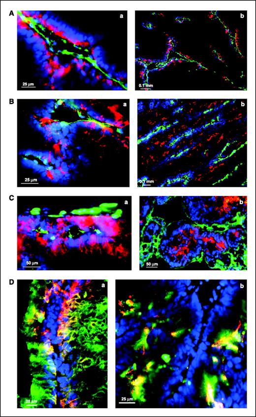 Figure 5. Immunofluorescence images showing the relationship between fluorescently labeled A5B7 distribution and tumor morphology in LS174T and SW1222 xenografts. A, distribution of A5B7 in LS174T at 5 min (a), ×40, and 1 h (b), ×20 montage. B, distribution of A5B7 in SW1222 at 5 min (a) ×40, and 1 h (b), ×20. C, high-power detail of antibody binding at 24 h to (a) perivascular tumor cells in LS174T ×40, and (b) luminal surface of tumor cells in SW1222 ×20. Red, antibody; green, blood vessel; blue, nuclei of cells adjacent to perfused vessels. D, antigen-antibody interaction at 1 h after antibody injection in LS174T (a) and SW1222 (b); magnification, ×40. Red, antibody; green, antigen; yellow, colocalization of antibody and antigen; blue, nuclei of cells adjacent to perfused vessels.