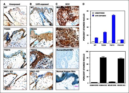 Figure 2. Immunostaining of Stat3. Mice were treated as described in the legend to Fig. 1. Mice were sacrificed at 3 h after the fourth UV exposure. Immunostaining for Stat3 was done as described in Materials and Methods. A, Stat3 immunostaining of unexposed wild-type (WT), PKCε-overexpressing transgenic (TG224 and TG215), and PKCε knockout (KO) mice. B, UVR-exposed wild-type, PKCε-overexpressing transgenic (TG224 and TG215), and PKCε knockout mice. C, Stat3 immunostaining of mouse SCC, human SCC with or without blocking peptide, and normal human skin. Arrows, Stat3 nuclear localization. Bar, 50 μm. Magnification, ×40. D, quantitation of Stat3-positive stained nuclei. Columns, mean from six different views; bars, SE.