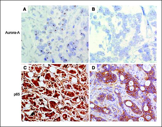 Figure 4. Aurora-A amplification was associated with NF-κB nuclear localization. A, invasive ductal carcinoma with Aurora-A gene amplification. Presence of more than five signals and signal clusters in the nuclei of neoplastic cells (original magnification, ×630). B, invasive ductal carcinoma without Aurora-A gene amplification. Presence of two to three copies of Aurora-A gene in the nuclei of the neoplastic cells (original magnification, ×630). C, p65 strong nuclear and cytoplasmic expression in samples with Aurora-A gene amplification (original magnification, ×200). D, p65 expression was restricted to the cytoplasmic compartment of neoplastic cells (original magnification, ×200).