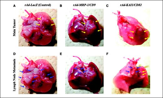 Figure 4. Macroscopic findings of resected lung and mediastinum from C57/BL6 mice, which underwent orthotopic implantation of LLC cells followed by intratracheal adenoviral gene deliveries [rAd-LacZ (A and D), rAd-MRP-1/CD9 (B and E), and rAd-KAI1/CD82 (C and F)]. Two pictures are shown for each group to show primary tumor and mediastinal lymph node metastasis separately. Yellow arrows, implanted primary tumors; blue arrows, mediastinal lymph node metastases. Primary tumor volumes showed no significant difference between any groups (A–C), but interestingly, great reduction was observed in the weights of mediastinal lymph node metastasis among those transfected with MRP-1/CD9 (E) and KAI1/CD82 (F) compared with those of LacZ (D).
