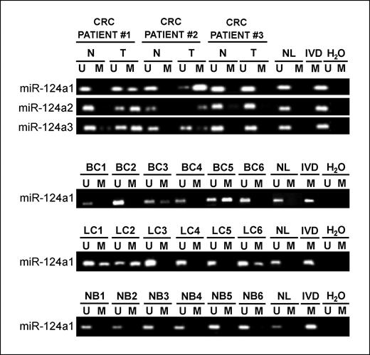 Figure 2. Methylation-specific PCR analyses for miR-124a methylation in primary human tumors. Unmethylated (U) or methylated (M) sequences. Normal lymphocytes (NL) and in vitro methylated DNA (IVD) are shown as unmethylated and methylated control sequences, respectively. Top, pairs of normal colon versus colorectal tumors from three different patients. Bottom, methylation-specific PCR analyses for miR-124a methylation in primary breast (top), lung (middle), and neuroblastoma (bottom) tumors. CRC, colorectal cancer.