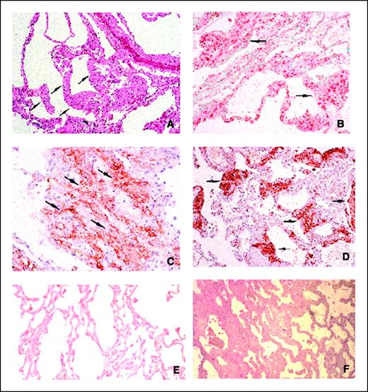 Figure 3. Immunohistochemical analysis of LAM tissue. Pulmonary explant stained with H&E (A) showing expansion of interalveolar septa (arrows) and emphysematous dilation of alveolar spaces. The LAM smooth muscle cells are positive for HMGA2 (B) and heavy caldesmon (arrows, brown reaction product in C). The immunoperoxidase stain for smooth muscle actin (D) shows bundles of smooth muscle cells (arrows, brown reaction product) within expanded alveolar spaces characteristic for LAM. HMGA2 immunostaining is present in most smooth muscle cells populating the thickened interalveolar septa (B, arrows). Both normal lung samples (E) and a sample from a patient with interstitial pulmonary fibrosis (F) did not react with the HMGA2 antibodies. Magnification, ×50 (A, B, E, and F); ×375 (C and D).