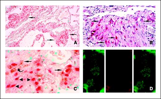 Figure 4. HMGA2 and HMB45 staining in LAM. HMB45 (A) and HMGA2 (B) staining is noted in the smooth muscle cells of the lung explants from the patients with LAM. Double immunolabeling (C) for HMGA2 (red nuclei) and HMB45 (brown cytoplasmic reaction product) shows colocalization of HMGA2 and HMB45 in smooth muscle cells in LAM (arrows). Occasional HMB45-positive cells are HMGA2 negative (curved arrow). Approximately 50% of HMGA2 positive cells in thickened alveolar septa of LAM show no staining for HMB45 (arrowheads). Magnification, ×375 (A and B); ×500 (C). D, confocal images (0.6-μm sections; magnification, 100×) of lung were acquired. Left, image showing HMGA2 immunoreactivity visualized using goat anti-rabbit IgG conjugated with FITC (green). Right, no HMB45 immunoreactivity was visualized using goat anti-mouse IgG conjugated with TRITC (red). Center, merged image of (A) and (B). Cells of varying sizes show HMGA2 immunoreactivity without any HMB45 immunostaining.
