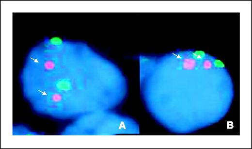 Figure 5. Representative FISH analysis for HMGA2 on lung tissue samples. FISH analysis in two separate patient tissue samples (A and B) using a gene-specific probe for HMGA2 (red) and control chromosome 12 centromere (green). The representative sample shows that individual cells consistently contain only two positive signals (arrows) for each probe.