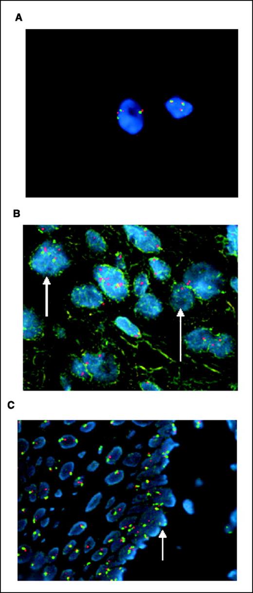 Figure 1. PTEN FISH analysis. A, FaDu cells showing aneuploidy. Three copies of the pericentromeric region of chromosome 10 (green) and the 10q23/PTEN locus (orange). Magnification, ×100. B, HNSCC patient tumor showing both PTEN aneuploidy (small arrow) and deletions (large arrow). C, HNSCC margin with loss of PTEN in the basal cell layer (arrow).