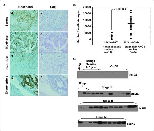 Figure 1. E-cadherin expression in ascites and tumor samples from ovarian cancer patients. A, samples were stained with antibodies to E-cadherin (1:200; a, c, e, and g) or H&E (b, d, f, and h) as described in Materials and Methods. a and b, serous carcinoma; c and d, mucinous carcinoma; e and f, clear cell carcinoma; g and h, endometrioid carcinoma. B and C, nonmalignant ascites samples (n = 13) were obtained from women diagnosed with benign ovarian cysts, OHSS, or Meigs syndrome (Meigs). Malignant ascites samples (n = 34) were obtained from women diagnosed with ovarian cancer at either stage I, III, or IV. B, patient ascites samples were analyzed using ELISA according to the manufacturer's specifications to determine the levels of sE-cad. C, ascites samples (1 μL) were diluted in PBS, electrophoresed on 9% SDS-PAGE gels, transferred to polyvinylidene difluoride (PVDF) membranes, and immunoblotted with anti-E-cadherin (HECD-1; 1:4,000) followed by peroxidase-conjugated secondary antibody (1:5,000) and enhanced chemiluminescence (ECL) detection. Whole-cell lysates from the OVCA433 cell lines served as a positive control for full-length (120 kDa) E-cadherin (data not shown).