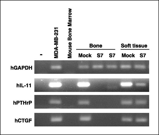 Figure 5. RNA was extracted from either bone or soft tissue (s.c.) metastatic lesions derived from mock and Smad7 (S7) inoculated tumor cells and analyzed by semiquantitative RT-PCR with primers specific for human IL-11 (hIL-11), human PTHrP (hPTHrP), human CTGF (hCTGF), or human GAPDH (hGAPDH). Left lane, PCRs run without cDNA templates. As a positive control, we used mRNA from cultured human breast adenocarcinoma cell line MDA-MB-231, known to express the genes of interest. Mouse bone marrow RNA was used as a negative control to ascertain the species specificity of the primers.