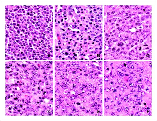 Figure 1. Histologic features of immunoblastic lymphomas and plasmacytoma. A, plasmacytic plasmacytoma with almost all mature cells with central nucleoli in clock-face nuclei, basophilic cytoplasm, and discernible Golgi. A binucleate cell is near the center of the field, and somewhat less mature plasmablasts are near the top. B, plasmacytic plasmacytoma, more pleiomorphic with a greater proportion of plasmablasts than in (A). Some apoptotic bodies and a mitosis can be seen. C, plasmablastic plasmacytoma with a near-uniform population of plasmablasts that vary significantly in size and have unusually large, magenta nuclei. Several mitoses are present along with active apoptosis. Occasional mature cells are seen, and one immunoblast at the top. D, plasmablastic plasmacytoma with great variation in cell size, apoptosis, and mitosis. E, anaplastic plasmacytoma with a mixture of immunoblasts and anaplastic cells as well as some plasmablasts. Note the absence of mature cells. F, immunoblastic lymphoma with large magenta nucleoli attached to the nuclear membrane. Note the presence of centroblasts with nuclei featuring vesicular chromatin and two nucleoli sited on the nuclear membrane and the absence of plasmablasts.