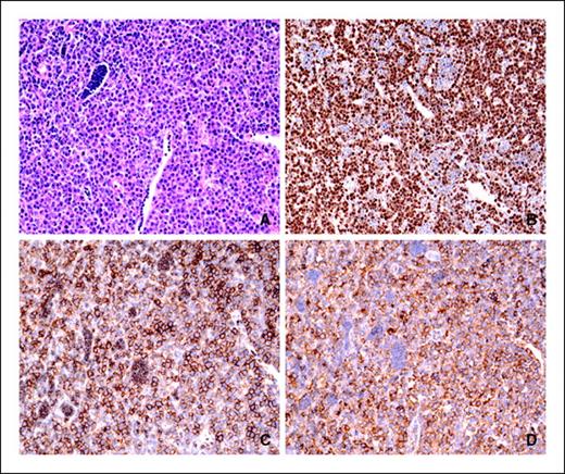 Figure 2. Immunohistochemical analyses of a plasmacytic plasmacytoma. Sections of formalin-fixed, paraffin-embedded tissue were stained with H&E (A) or reacted with antibodies to IRF4 (B), CD138 (C), and XBP1 (D), followed by appropriate second antibodies labeled with horseradish peroxidase. Original magnifications, ×40.
