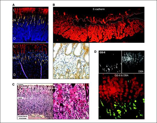 Figure 1. Lineage-specific labeling of normal mucosa and eHDGC. A, characterization of the lineage markers GS-II and DBA in human gastric mucosa. Top, vertical gastric units horizontally divided into the luminal pit cell compartment (L, red, DBA), the neck region including the upper, proliferative neck (N, green, GS-II), and the deep mucosa part (D) with chief cells (blue, pepsinogen II). Bottom, H+/K+ATPase β subunit antibody instead of pepsinogen antibody was used to stain parietal cells (blue), which are found in the lower two-thirds of gastric units. B, E-cadherin immunofluorescence (top) and immunohistochemistry (bottom) of eHDGC from two CDH1 mutation carriers. Dotted lines mark the lesion. C, HE section of mucosa containing eHDGC. Right, magnification of inset showing eHDGC with typical SRCs (arrow) in the luminal part and small SRCs or less differentiated cells at the eHDGC base (circle). D, eHDGC stained with GS-II (green) and DBA (red). Note the overlap of the GS-II positive eHDGC base and the neck region.