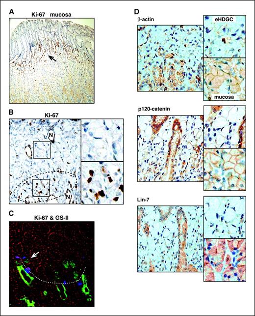 Figure 2. Expression of Ki-67 and junctional proteins in eHDGC. A, Ki-67 expression in the proliferative neck region (arrow) of normal mucosa of a mutation carrier. B, Ki-67 staining is present at the eHDGC base (circle) and in the neck of normal glands (N). Right, magnification of insets. C, small eHDGC base stained with Ki-67 (blue) and the neck marker GS-II (green). A few normal proliferative cells and a Ki-67/GS-II positive SRC (arrow) are seen at the eHDGC base (dotted line). All sections were also examined for apoptosis by TUNEL staining. Apoptotic cells were detected only in the normal surface epithelium, in which cells are shed into the lumen. D, junctional markers (β-actin, p120, and Lin-7) indicate dysfunctional adhesion in eHDGC.