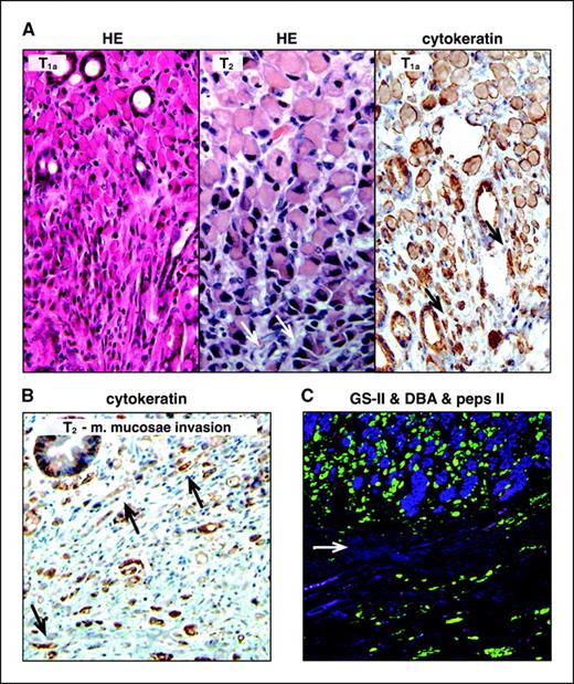 Figure 3. Correlation between dedifferentiation and deeper invasion. A, HE stain of an eHDGC, of a T2 HDGC, and a cytokeratin AE1/AE3 stain of an eHDGC. Note the transition from typical SRCs to poorly differentiated cells with increasing depth. Arrows, examples of dedifferentiated cells with mesenchymal-like appearance. B, cytokeratin stain of a T2 HDGC with poorly differentiated and dedifferentiated cells (arrows). C, lineage marker stain of a T2 HDGC at the mucosa/muscularis mucosae border (arrow). Only GS-II consistently stained poorly differentiated cells in stages ≥T1a.