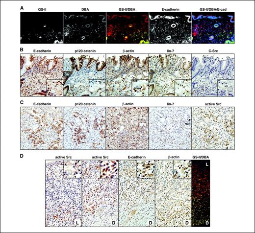 Figure 5. Junctional proteins, c-Src kinase, and gastric lineage markers in early sporadic DGC. A, sporadic intramucosal SRCC stained with GS-II (green), DBA (red), and E-cadherin (blue). Note the reduced/absent expression of E-cadherin in the GS-II/DBA–marked cancer cells. B, serial sections of an intramucosal SRCC stained for junctional proteins and c-Src. Insets, magnifications of the central lesion. C, serial sections of an intramucosal SRCC from a patient with partially preserved E-cadherin expression. Note the similar staining pattern of E-cadherin, p120, and active c-Src. D, serial sections of a sporadic intramucosal SRCC. The luminal section part (L) is shown only for c-Src. The deep part (D) is also shown for E-cadherin and β-actin (note their reduced/cytoplasmic expressions). SRCs are found predominantly in the luminal part. Right, the complete section stained with GS-II (green), DBA (red), and pepsinogen II (blue).