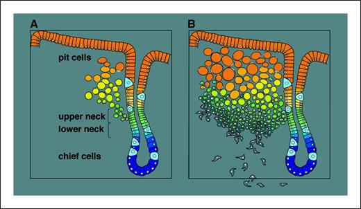 Figure 6. A model for the development of DGC. A, early intramucosal eHDGC with the proliferative base at the upper neck region and differentiating SRCs towards the lumen. B, an expansion of poorly differentiated cells below the eHDGC base and concomitant activation of c-Src is associated with an EMT and the invasion beyond the gastric mucosa.