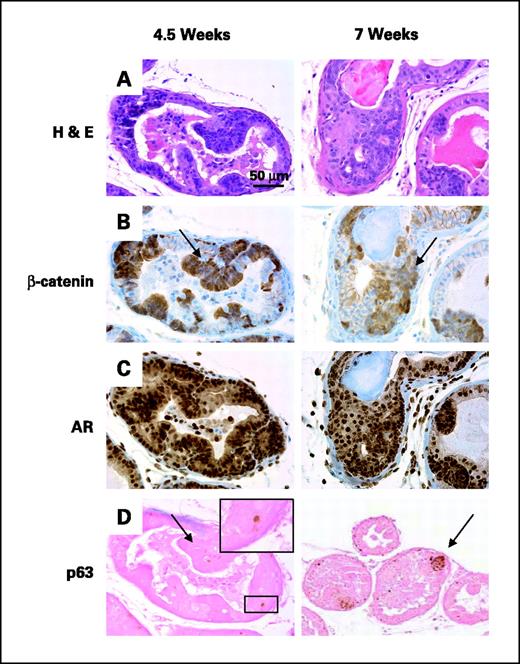 Figure 2. Regions of hyperplasia evident in 4.5- and 7-wk-old PB-Cre+;Apcflox/flox mice. A, H&E of 4.5-wk-old (left) and 7-wk-old (right) PB-Cre+;Apcflox/flox prostate tissue. B, β-catenin immunohistochemistry of sections consecutive to those shown in (A). Note the regions of stabilized β-catenin (right and left, arrows). C, AR immunohistochemistry of sections from the same region shown in (A and B). D, p63 immunohistochemistry at 4.5 wks (left) and 7 wks (right) In (D), note the presence of the solitary p63-positive basal cell characteristic of staining seen in control tissues (left, inset) and the cluster of p63-positive cells in the hyperplastic region (right, arrow).
