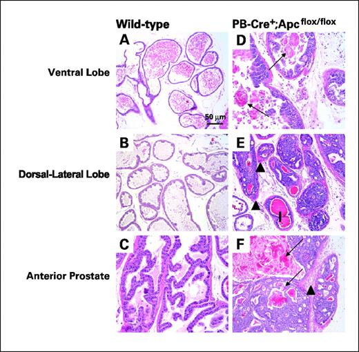 Figure 3. Prostate adenocarcinoma development in 7-mo-old PB-Cre+;Apcflox/flox mice. A to C, ventral (A), dorsal-lateral (B), and anterior (C) lobe sections from WT mouse prostate. D to F, ventral (D), dorsal-lateral (E), and anterior (F) lobe sections from the prostate of a PB-Cre+;Apcflox/flox mouse. Arrows, areas of keratinization; arrowheads, areas of inflammation.