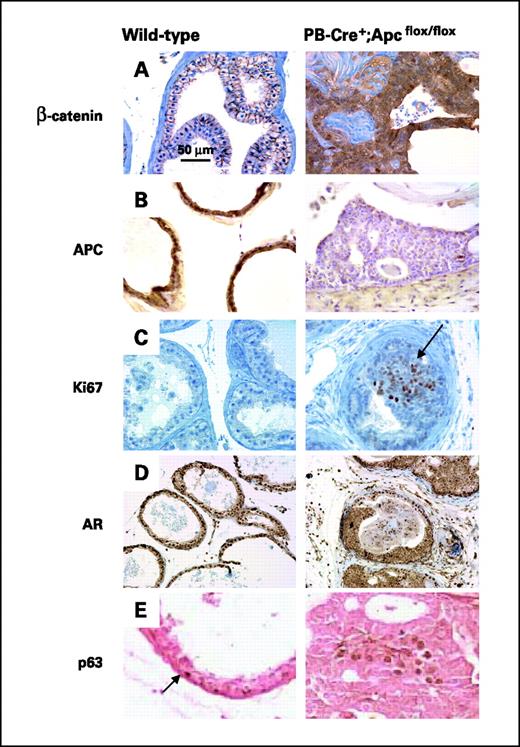 Figure 4. Cytoplasmic levels of β-catenin are increased, but levels of APC are decreased, in prostates of 7-mo-old PB-Cre+;Apcflox/flox mice. A, left, β-catenin immunohistochemistry of WT prostate, showing the localization of β-catenin at the cell membrane consistent with its function in adherens junctions; right, β-catenin immunohistochemistry of PB-Cre+;Apcflox/flox prostate, showing widespread stabilization of β-catenin. B, Apc immunohistochemistry of WT prostate (left) and PB-Cre+;Apcflox/flox prostate (right). Note the lack of Apc immunoreactivity in the hyperplastic tissue. C, Ki67 immunohistochemistry of WT prostate (left) and PB-Cre+;Apcflox/flox prostate (right). Note pocket of Ki67 cells (arrow). D, AR immunohistochemistry of WT prostate (left) and PB-Cre+;Apcflox/flox prostate (right). E, left, p63 immunohistochemistry of WT prostate. Note basal cells positive for p63 (arrow). Right, p63 immunohistochemistry of PB-Cre+;Apcflox/flox prostate. Some tumors contain areas with pockets of cells stably expressing p63. Higher magnification E, right.