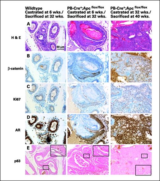 Figure 5. Androgen is necessary for tumor formation but is not necessary for tumor maintenance. Left, prostate tissue from WT mice castrated at 6 wks and sacrificed at 32 wks; middle, prostate tissue from PB-Cre+;Apcflox/flox mice castrated at 6 wks and sacrificed 32 wks; right, prostate tissue from PB-Cre+;Apcflox/flox mice castrated at 32 wks and sacrificed at 40 wks. A, H&E staining. B, β-catenin staining. C, Ki67 staining. D, AR staining. E, p63 staining. The regions from which higher power views in (E) are taken are indicated by the small boxes.