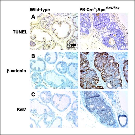 Figure 6. Androgen ablation does not lead to apoptosis of all tumor cells in PB-Cre+;Apcflox/flox mice. A to C, left, prostate tissue from a WT adult mouse castrated and sacrificed 4 d later; right, prostate tissue from a PB-Cre+;Apcflox/flox mouse castrated and sacrificed 4 d later. TUNEL staining for cell death/apoptosis (A). Note the extensive staining in the WT tissue (left) compared with the PB-Cre+;Apcflox/flox tumor (right). β-catenin immunohistochemistry (B). Ki67 immunohistochemistry (C). Both β-catenin and Ki67 staining are elevated in the PB-Cre+;Apcflox/flox samples.