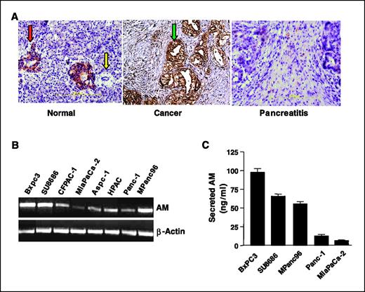 Figure 1. Adrenomedullin is expressed in pancreatic cancer tissues and cell lines. A, immunohistochemistry showing the expression of adrenomedullin in human normal pancreas, pancreatic adenocarcinoma, and chronic pancreatitis (n = 5; original magnification, ×20). Arrows, adrenomedullin staining in the islets of the pancreas (normal tissue); adrenomedullin staining in the cancer epithelium (pancreatic cancer tissues). B, RT-PCR showing the expression of adrenomedullin mRNA in human pancreatic cancer cell lines and β-actin as control. C, ELISA showing the secretion of adrenomedullin in conditional medium of pancreatic cancer cell lines. Columns, mean for three experiments; bars, SE.
