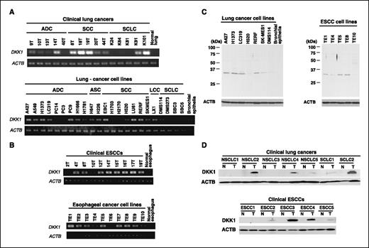 Figure 1. Expression of DKK1 in tumor tissues and cell lines. A, expression of DKK1 in a normal lung tissue and 15 clinical lung cancer samples [lung adenocarcinoma (ADC), lung SCC, and SCLC; top] and 23 lung cancer cell lines (bottom) detected by semiquantitative RT-PCR analysis. B, expression of DKK1 in a normal esophagus and 10 clinical ESCC tissue samples and 10 ESCC cell lines detected by semiquantitative RT-PCR analysis. C, expression of DKK1 protein in seven lung cancer cell lines (left) and in five ESCC cell lines (right) examined by Western blot analysis. D, expression of DKK1 protein in representative pairs of five NSCLC and two SCLC samples (top) and in those of five ESCCs (bottom).
