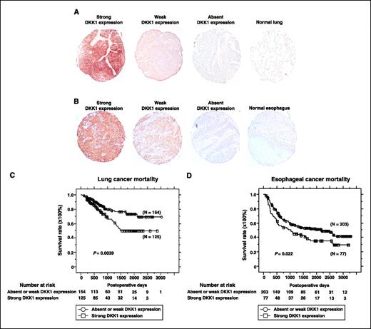 Figure 3. Association of DKK1 overexpression with poor prognosis of NSCLC and ESCC patients. A and B, examples for strong, weak, and absent DKK1 expression in cancer tissues and a normal tissue. Original magnification, ×100. A, lung SCC. B, ESCC. C and D, Kaplan-Meier analysis of survival of patients with NSCLC (P = 0.0039, log-rank test; C) and ESCC (P = 0.022, log-rank test; D) according to expression of DKK1.
