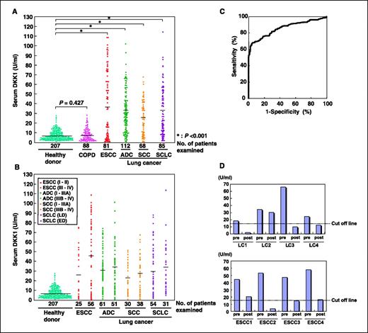 Figure 4. Serologic concentration of DKK1 determined by ELISA in patients with ESCC or lung cancer and in healthy controls or nonneoplastic lung disease patients with COPD. A, distribution of DKK1 in sera from patients with ESCC, lung adenocarcinoma, lung SCC, or SCLC. Black lines, average serum levels. Differences were significant between ESCC patients and healthy individuals/COPD patients (P < 0.001, respectively, Mann-Whitney U test), between adenocarcinoma patients and healthy individuals/COPD patients (P < 0.001), between SCC patients and healthy individuals/COPD patients (P < 0.001), and between SCLC patients and healthy/COPD individuals (P < 0.001). The difference between healthy individuals and COPD patients was not significant (P = 0.427). B, distribution of DKK1 in sera from patients at various clinical stages of ESCC, lung adenocarcinoma, lung SCC, or SCLC. LD, limited disease; ED, extensive disease. C, ROC curve analysis of DKK1 as serum markers for lung and esophageal cancers. X axis, 1-specificity; Y axis, sensitivity. D, serologic concentration of DKK1 before and after surgery (postoperative days at 2 months) in patients with NSCLC (top) and ESCC (bottom). The cutoff level was set to provide optimal diagnostic accuracy and likelihood ratios (minimal false-negative and false-positive results) for DKK1 [i.e., 14.7 units/mL with a sensitivity of 68.2% (236 of 346) and a specificity of 95.2% (197 of 207)].