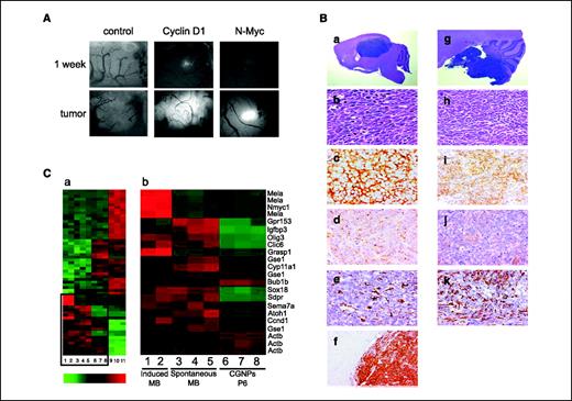 Figure 3. Enforced expression of N-Myc and cyclin D1 in P5 CGNPs from p53−/−, Ink4c−/− mice induces medulloblastoma after orthotopic transplantation into the cerebral cortex. A, in vivo fluorescence imaging of tumor development from infected CGNPs implanted into the brains of immunocompromised CD-1 nu/nu recipient mice. Purified CGNPs from Ink4c−/−, p53−/− mice were infected with retroviral vectors expressing cyclin D1 or N-Myc together with GFP or with a control virus expressing GFP alone (top). B, histopathology of brain tumors arising after injection of Ink4c, p53 doubly deficient CGNPs overexpressing N-Myc (a–f) compared with that in tumors arising in irradiated Ink4c−/−, p53FL/−, Nestin-Cre+ mice (g–k). a, H&E staining of tumor tissue developing from cells injected into the cerebral cortex versus that of a cerebellar tumor arising in an irradiated Ink4c−/−, p53FL/−, Nestin-Cre+ mouse (g). b and h, H&E staining (magnification, ×400) showing the typical morphology of medulloblastoma cells. c and i, tumor cells stained strongly for class III β-tubulin (TUJ1; magnification, ×400) and showed diffuse expression of synaptophysin (magnification, ×400). d and j, both of which are neuronal markers. e and k, like human medulloblastomas, many mouse tumors showed glial differentiation as evidenced by sporadic GFAP expression (magnification, ×400). f, tumor cells stained positively for GFP (magnification, ×400) as opposed to adjacent normal tissue that did not. C, microarray analysis of medulloblastomas arising orthotopically (lanes 1 and 2) and spontaneously (lanes 3–5) and of CGNPs from WT P6 pups (lanes 6–8) and P5 total cerebellum (lanes 9–11). Microarray data were subjected to ANOVA and genes that changed >1.9-fold between the indicated groups (with adjusted P values <0.01 and maximum absolute intensity difference >32 units) were considered differentially expressed (a). Colors represent relative expression level. Red, high expression; green, low expression (see gradient). Genes were clustered based on expression pattern among the four groups. b, an expanded view of the boxed area in (a) that contains genes overexpressed in medulloblastoma samples. The individual gene names (right) correspond to the denoted rows in the cluster.