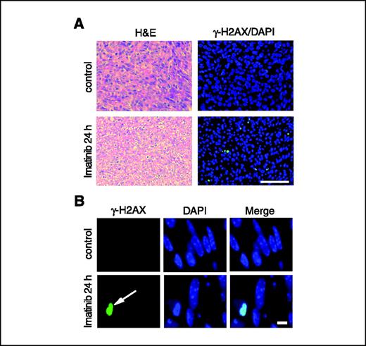 Figure 5. In vivo up-regulation of H2AX following imatinib treatment. A, histomorphologic (H&E) and immunofluorescence analysis of GISTs in KITV558Δ/+ mice after either 24 h placebo treatment or treatment with imatinib. Note the scattered γ-H2AX–positive tumor cells following imatinib treatment. Nuclei stained with DAPI. Bar, 100 μm. B, high-power magnification of γ-H2AX–positive rodent GIST cells after imatinib treatment. Note the γ-H2AX–positive tumor cell with chromatin aggregation (arrow). Nuclei stained with DAPI. Bar, 10 μm.
