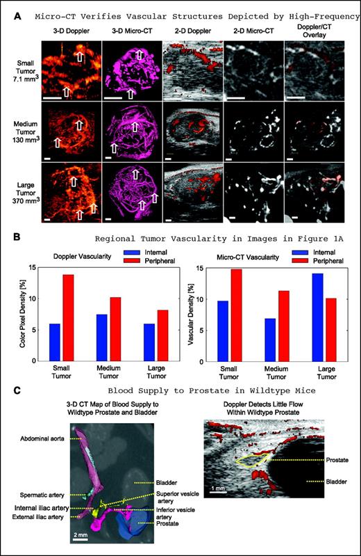 Figure 1. Power Doppler ultrasound images of vasculature in a GEM-prostate cancer model are verified by Microfil-enhanced micro-CT. A, from left to right in the first row, a three-dimensional power Doppler image, a three-dimensional micro-CT image, a two-dimensional plane from the three-dimensional power Doppler image, the matching two-dimensional plane from the three-dimensional micro-CT image, and an overlay of the two-dimensional power Doppler and micro-CT images of a 7.1-mm3 tumor. Second and third rows, equivalent sequences of images from a 130-mm3 tumor and 370-mm3 tumor, respectively. Arrows, sites used for registration of corresponding vessels. Bars, 1 mm. B, bar graphs of internal and peripheral vascularity estimated from the three-dimensional power Doppler and micro-CT images shown in (A). The power Doppler and micro-CT vascularity metrics (CPD and vascular density, respectively) are shown on separate graphs. C, Doppler and CT images of the blood supply to a normal prostate and surrounding tissues are presented as controls for comparison with the images of tumor vasculature. The superior and inferior vesical arteries branch from the internal iliac artery toward the bladder and prostate, but only the inferior vesical supplies the prostate.