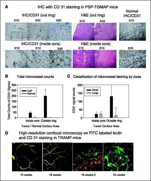 Figure 2. Immunohistochemistry (IHC) and high-resolution confocal microscopy of FITC-labeled lectin and CD31 staining in GEM-prostate cancer models (PSP-TGMAP and TRAMP). A, immunohistochemistry by CD31 in frozen sections prepared from freshly dissected large tumors (2.5 cm in diameter, at 28 wks of age) in PSP-TGMAP mice. Areas of the outer ring (top) and innner core (bottom) were analyzed separately. Magnified (×20 and ×40) views of the boxed region in the ×10 image are also shown. H&E (middle) and normal prostate tissue (right) were used as control. Graphs (C and D) show comparisons of CD31 signals for microvessel distribution using total microvessel counts (B) and classification of small (10–30 μm) and large (100 μm) vessels in the normal prostate tissue and outer ring and inner core of large tumors. D, in vivo FITC-lectin perfusion (green) and postfixation immunohistochemistry to detect CD31 (red) in TRAMP mice. Prostate vasculature is essentially normal at 12 wks of age. At 18 wks, the PIN phenotype or well- to moderately differentiated adenocarcinomas (18 wks −2) were highly angiogenic. In 24-week-old TRAMP mice, in the interior of large poorly differentiated tumors, regions of hemorrhage (arrowheads) were shown by the pooling of FITC-lectin. Magnification, 40×; 325 × 325 μm of specimen.