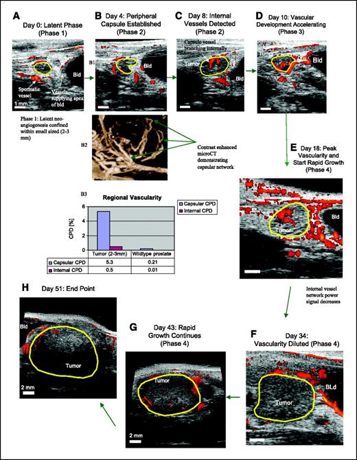Figure 3. A–H, longitudinal study of GEM-prostate cancer using power Doppler imaging demonstrating the four distinct phases of tumor-associated angiogenesis development in a PSP-TGMAP mouse (27 weeks of age). This sequence of two-dimensional images spans a 51-day observation period beginning when the mouse was at age 19 weeks. Days 0 to 34 images are displayed in a sagittal plane; bars, 1 mm. Days 43 and 51 images are displayed in a transverse plane; bars, 2 mm. I–M, demonstration of peripheral capsular structures, which are hypothesized to be neoangiogenesis initiation sites. I, a two-dimensional Doppler image of a small tumor (1.88 mm3 volume, 1.8 mm maximum diameter) in a 60-week-old mouse that had not yet developed a peripheral capsular vascular structure. J, three-dimensional Doppler image showing a developing peripheral capsular vascular structure in a 2.1-mm3 (1.6 mm maximum diameter) tumor in a 19-week-old mouse. K, coronal view of three-dimensional Doppler and gray-scale image showing a 4-mm-diameter tumor in 27-week-old mouse that possesses well-defined capsular vascularity. L, three-dimensional Doppler image showing the peripheral capsular vascular structure of a 320-mm3 (8.0-mm-diameter) tumor in a 34-week-old mouse. M, gross pathology photograph of a very large (about 20 mm diameter) tumor in a 32-week-old mouse taken after injection of Microfil. N–P, graphs derived from the longitudinal study depicted in A–H summarize changes in tumor vascularity (measured by CPD) as a function of time (in days). N, tumor volume (blue) and vascularity measured over the entire tumor (red). O, coincident timing of vascularity peaks measured over the entire tumor (red), the peripheral region of the tumor (purple), and the internal portion of the tumor (black). P, the ratio of internal CPD to peripheral CPD (green) peaks just before the tumor volume (blue) enters its rapid growth phase.