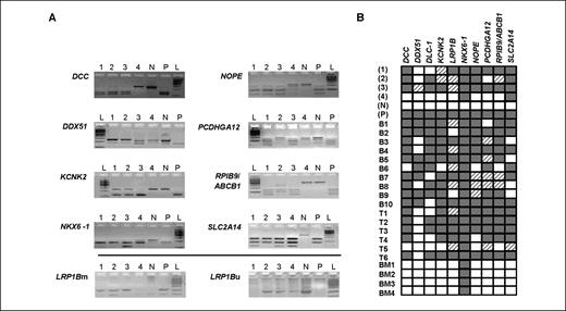 Figure 1. A, gel images and summary of results of methylation present in 10 CGI clones associated with 11 genes (DLC-1 was validated using qMSP; therefore, no gel images are available) in four ALL cell lines. 1, Jurkat; 2, MN-60; 3, NALM-6; 4, SD-1; N, bisulfite-treated normal PBL DNA; P, SssI and bisulfite-treated normal PBL DNA; L, ladder. The gel images above the solid line are the results of COBRA analysis and the gel images below the solid line are the results of MSP. LRP1Bm: assay for methylated allele; LRP1Bu: assay for unmethylated allele. B, validation summary of methylation present in 10 CGI clones associated with 11 genes identified by the DMH analysis in 4 ALL cell lines (1, Jurkat; 2, MN-60; 3, NALM-6; 4, SD-1), a negative control (N, normal peripheral blood DNA), a positive control (P, SssI-treated normal peripheral blood DNA), 10 B-ALL patients (B1–B10), 6 T-ALL patients (T1–T6), and 4 normal controls (BM1–BM4). DLC-1 was validated by real-time qMSP assay, LRP1B was validated by qMSP, and the remaining genes were validated by COBRA. Analysis of gel images (see A) resulted in scoring a sample as methylated (gray blocks), partially methylated (hatched blocks), or not methylated (white blocks). Column, gene; row, sample.
