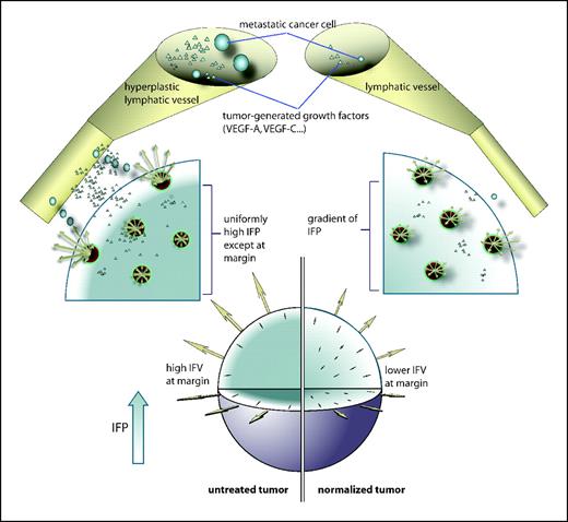 Figure 1. The tumor is modeled as a sphere of radius R embedded in a body fluid (e.g., peritoneal cavity, pleural cavity) or host tissue. The interstitial fluid oozing from the tumor periphery carries therapeutics (e.g., monoclonal antibodies), growth factors (e.g., VEGF-A, VEGF-B, VEGF-C, and VEGF-D), and cells (e.g., metastatic cells) into the surrounding fluid/tissue. The result may be higher fluxes of cancer cells and growth factors from the tumor into the surrounding tissue or body fluid. The growth factors (including VEGF-A, VEGF-B, VEGF-C, and VEGF-D) can induce angiogenesis and lymphangiogenesis, and the cancer cells can contribute to metastatic dissemination via the lymphatic or blood vessels. Fluid seeping from the tumor surface can also cause edema (e.g., around brain tumors) and ascites formation (e.g., ovarian cancer). Antiangiogenic therapy can normalize the tumor vasculature, leading to lower IFP at the center, less steep IFP gradients, and lower fluid flow rates at the tumor margin, thus potentially reducing peritumor edema, ascites formation, and lymphatic metastasis. Furthermore, the normalized vessels may be more resistant to cancer cell intravasation, a prerequisite for hematogenous metastasis.