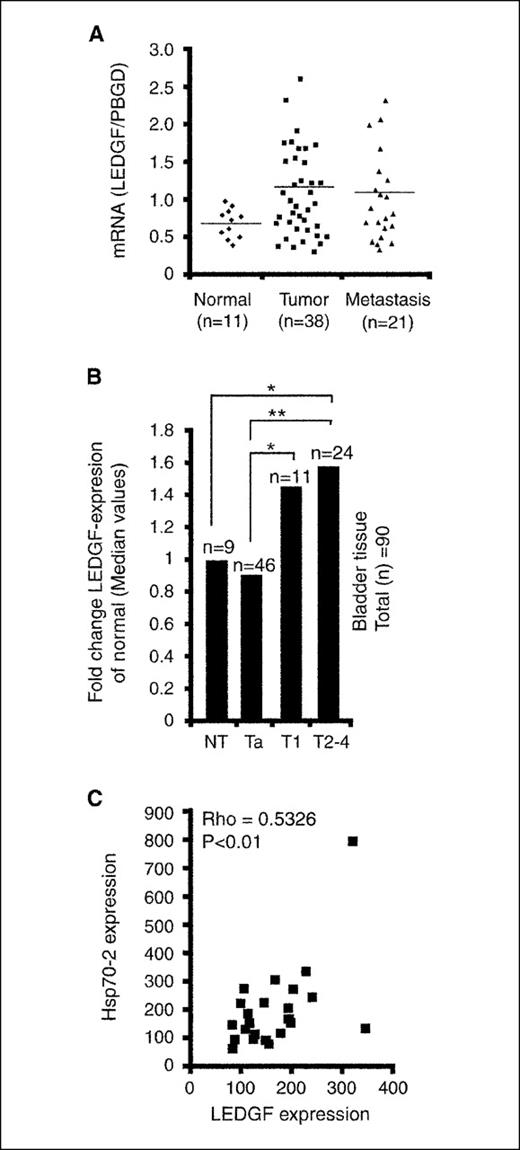 Figure 6. The expression of LEDGF mRNA is up-regulated in breast and bladder cancer. A, LEDGF mRNA expression levels in human mammary biopsies originating from normal, primary tumor or metastatic tumor samples were determined by real-time RT-PCR. Each dot represents an independent tissue sample where LEDGF levels are depicted relative to PBGD levels. Horizontal lines, median values. P > 0.05. B, median values of LEDGF expression in 90 samples of bladder tissue sorted according to pathologic definitions as normal epithelium (NT), benign tumor (Ta), subepithelium/connective tissue–invasive carcinoma (T1), and muscle-invasive carcinoma (T2-4). *, P value <0.05; **, P value <0.01. C, comparison of LEDGF and Hsp70-2 mRNA expression in 9 samples of normal bladder tissue and 24 samples of muscle-invasive bladder cancer. The significance of correlation was analyzed by Pearson's product moment test: Rho = 0.5326; P value <0.01.