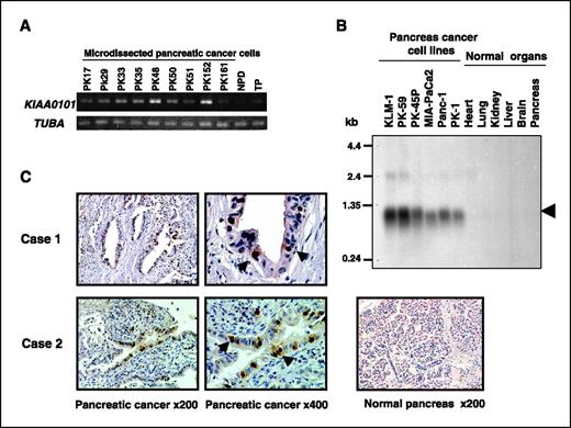 Figure 1. Overexpression of KIAA0101 in pancreatic cancer cells. A, semiquantitative RT-PCR validated that KIAA0101 expression was up-regulated in the microdissected pancreatic cancer cells, compared with normal pancreatic ductal (NPD) cells, which were also microdissected, and whole normal pancreatic tissue (TP). Expression of TUBA served as the quantitative control. B, Northern blot analysis showed the high level of KIAA0101 expression in six pancreatic cancer cell lines (lanes 1–6), whereas its expression was hardly detectable in vital organs, including heart, lung, liver, kidney, and brain (lanes 7–11). C, immunohistochemical study using anti-KIAA0101 polyclonal antibody. Intense staining was observed in the nuclei of pancreatic cancer cells (arrowhead, ×400), whereas acinar cells and normal ductal epithelium in normal pancreatic tissue showed no staining.