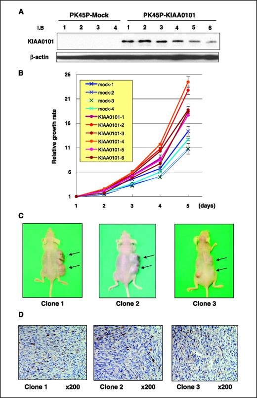 Figure 3. Exogenous overexpression of KIAA0101 promoted cancer cell growth and transformed NIH3T3. A, Western blot analysis of six PK-45P derivative cells (clones 1–6) expressing exogenous KIAA0101 constitutively and those transfected with mock vector (Mock 1–4). Exogenous introduction of KIAA0101 expression was validated with anti-HA tag antibody. Anti-β-actin antibody served as a loading control. B, the growth rate measured by MTT assay shows that the six clones expressing KIAA0101 (1–6, red lines) grew significantly more rapidly than the four mock-clones (Mock 1–4, dash lines; P < 0.05, Student's t test). X-axis, day points after seeding; Y-axis, relative growth rate calculated in absorbance of the diameter by comparison with the absorbance value of day 1 as a control. Points, average; bars, SE. The experiences were in triplicate altogether. C, KIAA0101-expressing clones and three mock clones were established from NIH3T3 cells. Three NIH3T3 clones expressing KIAA0101 (clones 1–3) and the mock NIH3T3 clones were inoculated in the right and left flank of 8-week-old nude mice, respectively. After 4 wks, NIH3T3 clones expressing KIAA0101 formed the large mass at the right frank of nude mice. D, each of the tumors was immunostained by anti-KIAA0101 antibody, validating the exogenous KIAA0101 expression.