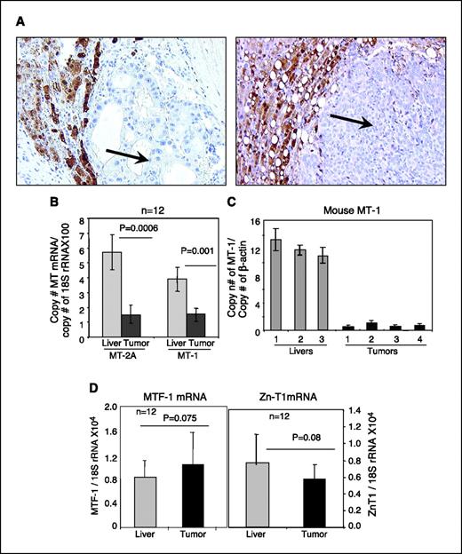 Figure 1. A, immunohistochemical analysis shows dramatic decrease of MT protein level in HCCs. Formalin-fixed tissue sections were incubated with anti-MT mouse monoclonal antibody followed by horseradish peroxidase–conjugated antimouse IgG. The color was developed by avidin-biotin method. The arrow indicates the cancerous region of the tissue section and the adjacent area is the normal liver tissue. B, real-time PCR analysis showed significant down-regulation of MT-2A and MT-1 expression in human HCC compared with matching normal liver tissues. cDNA (∼100 ng) was subjected to real-time RT-PCR with MT-2A–specific primers and primers common to all isoforms of MT-1. 18S rRNA was amplified from the same cDNA (∼1 ng), and copy numbers of MT-2A and MT-1 were normalized to that of 18S rRNA. C, MT-1 expression is dramatically decreased in diethylnitrosamine-induced liver tumors in mice. cDNAs from tumors and age-matched control livers were subjected to real-time RT-PCR with primers specific for MT-1 and β-actin. Each sample was assayed in triplicate. Columns, mean of three values; bars, SD. D, mRNA levels of MTF-1 and Zn-T1 are not significantly altered between the tumor and normal tissues. Total RNA isolated from 12 HCCs and matching livers were subjected to real-time RT-PCR with MTF-1– and Zn-T1–specific primers and normalized to 18S rRNA. Columns, mean of three values; bars, SD.