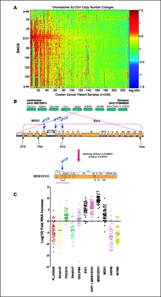 Figure 1. EVI1 genomic copy number increase is associated with a selective accumulation of EVI1 and MDS1/EVI1 transcripts. A, CGH analysis for 235 ovarian tumors using a contig encompassing 163 BACs probes on 3q is shown as a scaled image map. The signal for the EVI1 BAC is the maximum signal intensity across the group of BACs for EVI1 region. The patient samples are ordered with respect to decreasing EVI1 copy number alterations from left to right. The BACs on chromosome 3q are ordered by position along the chromosome. Parametric and nonparametric correlation analyses were done to delineate the region of highest correlation on 3q. Data vectors for each BAC on chromosome 3q were created, and correlation coefficients were determined for each BAC compared with every other BAC on the chromosome. The region on 3q from PDCD10 to MYNN (Chr3:168722613-170908630) was the most frequently altered area on 3q when compared with the frequency of change for other regions. In addition, BACs within this region exhibited the most statistically significant direct correlation with other BACs in the region. B, genomic organization surrounding MDS1 and EVI1. Open reading frames within the minimally aberrant region on 3q are organized from centromere to telomere. MDS1 and EVI1 as well as the MDS1/EVI1 intergenic read-through are shown in detail. The MDS1/EVI1 intergenic transcript contains exon I and exon II of the MDS1 coding sequence, followed by the untranslated region of EVI1 (exon II), respectively, giving rise to a novel PR domain and the complete open reading frame of EVI1. The location of the qPCR primers for MDS1 (exon IV), MDS1/EVI1 (PR domain), and EVI1 (two independent probe sets: one against exon I and the other against exon III) are indicated. C, RNA expression levels of genes surrounding EVI1 along chromosome 3q, from PDCD10 to MYNN, were assessed by quantitative PCR (qPCR) analysis in ovarian tissue samples. The results are displayed as log10 fid RNA alterations for NOE and advanced tumors (stages III and IV), compared with the average of the normal epithelium. The EVI1 exon I probe is specific for EVI1 alone (specifically EVI1d), the EVI1 exon III probe recognizes both EVI1 and MDS1/EVI1 levels (denoted as EVI1 + MDS1/EVI1), whereas the MDS1/EVI1 probe is specific to the fusion gene. PDCD10, programmed cell death 10; Serpini1, a serine/cysteine proteinase inhibitor, GOLPH4, Golgi phosphoprotein 4, ARPM1, an actin-related protein, and MYNN, myoneurin zinc finger protein. D, the results from C are displayed as fold RNA for normal OSE and serous epithelial advanced stage ovarian cancers. EVI1 in this graph is shown using exon III probe (EVI1 + MDS1/EVI1). E, RNA expression levels of total EVI1 and MDS1/EVI1 (exon III qPCR probes), EVI1 (exon I qPCR probes), MDS1/EVI1, and MDS1 were assessed by quantitative PCR analysis in ovarian tissue samples by stage as fold alterations in RNA expression compared with that of normal epithelium. Normal and benign cystadenomas, stages I and II, as well as stages III and IV, were grouped together to increase sample size. Both stage I/II and stage III/IV were significantly increased from normal/benign.