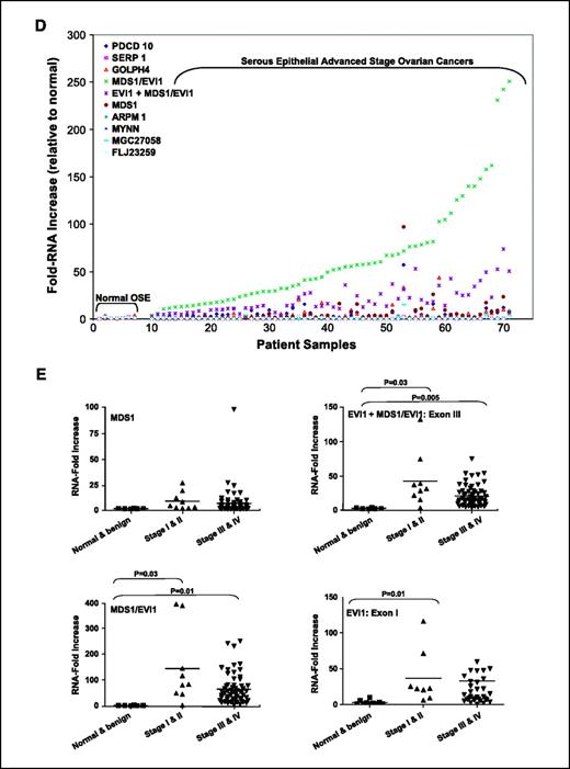 Figure 1. EVI1 genomic copy number increase is associated with a selective accumulation of EVI1 and MDS1/EVI1 transcripts. A, CGH analysis for 235 ovarian tumors using a contig encompassing 163 BACs probes on 3q is shown as a scaled image map. The signal for the EVI1 BAC is the maximum signal intensity across the group of BACs for EVI1 region. The patient samples are ordered with respect to decreasing EVI1 copy number alterations from left to right. The BACs on chromosome 3q are ordered by position along the chromosome. Parametric and nonparametric correlation analyses were done to delineate the region of highest correlation on 3q. Data vectors for each BAC on chromosome 3q were created, and correlation coefficients were determined for each BAC compared with every other BAC on the chromosome. The region on 3q from PDCD10 to MYNN (Chr3:168722613-170908630) was the most frequently altered area on 3q when compared with the frequency of change for other regions. In addition, BACs within this region exhibited the most statistically significant direct correlation with other BACs in the region. B, genomic organization surrounding MDS1 and EVI1. Open reading frames within the minimally aberrant region on 3q are organized from centromere to telomere. MDS1 and EVI1 as well as the MDS1/EVI1 intergenic read-through are shown in detail. The MDS1/EVI1 intergenic transcript contains exon I and exon II of the MDS1 coding sequence, followed by the untranslated region of EVI1 (exon II), respectively, giving rise to a novel PR domain and the complete open reading frame of EVI1. The location of the qPCR primers for MDS1 (exon IV), MDS1/EVI1 (PR domain), and EVI1 (two independent probe sets: one against exon I and the other against exon III) are indicated. C, RNA expression levels of genes surrounding EVI1 along chromosome 3q, from PDCD10 to MYNN, were assessed by quantitative PCR (qPCR) analysis in ovarian tissue samples. The results are displayed as log10 fid RNA alterations for NOE and advanced tumors (stages III and IV), compared with the average of the normal epithelium. The EVI1 exon I probe is specific for EVI1 alone (specifically EVI1d), the EVI1 exon III probe recognizes both EVI1 and MDS1/EVI1 levels (denoted as EVI1 + MDS1/EVI1), whereas the MDS1/EVI1 probe is specific to the fusion gene. PDCD10, programmed cell death 10; Serpini1, a serine/cysteine proteinase inhibitor, GOLPH4, Golgi phosphoprotein 4, ARPM1, an actin-related protein, and MYNN, myoneurin zinc finger protein. D, the results from C are displayed as fold RNA for normal OSE and serous epithelial advanced stage ovarian cancers. EVI1 in this graph is shown using exon III probe (EVI1 + MDS1/EVI1). E, RNA expression levels of total EVI1 and MDS1/EVI1 (exon III qPCR probes), EVI1 (exon I qPCR probes), MDS1/EVI1, and MDS1 were assessed by quantitative PCR analysis in ovarian tissue samples by stage as fold alterations in RNA expression compared with that of normal epithelium. Normal and benign cystadenomas, stages I and II, as well as stages III and IV, were grouped together to increase sample size. Both stage I/II and stage III/IV were significantly increased from normal/benign.