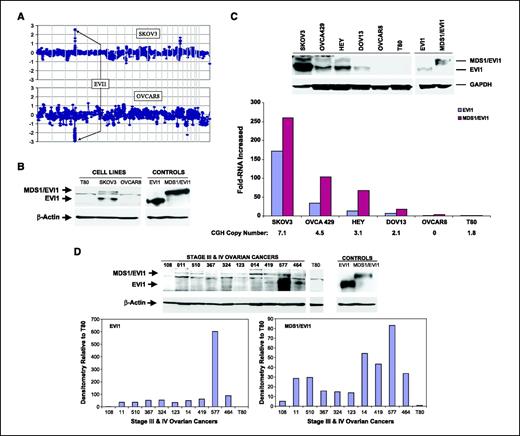 Figure 2. EVI1 genomic copy number increase is associated with a selective accumulation of EVI1 and MDS1/EVI1 protein. A, CGH profiles of SKOV3 and OVCAR8 cells are displayed showing EVI1 amplified at the 3q26.2 locus in SKOV3 cells and deleted in OVCAR8 cells. B, Western analysis was done in T80, SKOV3, and OVCAR8 cell lines and with EVI1 and MDS1/EVI1 transfected in T80 cells as positive controls (CONTROLS) using polyclonal antibody recognizing both EVI1 and MDS1/EVI1. β-Actin was used as loading control. C, Western analysis was done in SKOV3, OVCA429, HEY, DOV13, OVCAR8, and T80 cells and with EVI1 and MDS1/EVI1 transfected in T80 cells as positive controls (CONTROLS) using an antibody that recognizes both EVI1 and MDS1/EVI1. qPCR for EVI1 and MDS1/EVI1 was done in ovarian cell lines. The results are displayed as fold-RNA expression normalized to T80; CGH copy number for the cell lines is indicated below the lines. Experiments were done in triplicate. D, Western analysis of EVI1 was done using the antibody that recognizes both EVI1 and MDS1/EVI1 in advanced ovarian patient samples. T80 cells transfected with EVI1 and MDS1/EVI1 were used as positive controls. Densitometric analysis of EVI1 and MDS1/EVI1 levels in advanced-stage ovarian cancer patients normalized to T80 protein is presented.