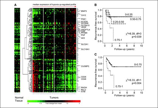 Figure 1. A, dendogram of 11 normal tissue samples and 59 HNSCC. Two HSs were calculated for each patient by looking at the distribution of the level of RNA expression of up-regulated and down-regulated hypoxia-associated gene (HS-up and HS-down). The median of this distribution was then calculated for each patient. X axis, patients are ordered by increasing HS-up; Y axis, results of hierarchical clustering on all the genes. The guidelines indicate the median and quartiles of the HS-up for the 59 patients. B, Kaplan-Meier plot of recurrence-free survival in 60 patients with HNSCC stratified according to HS-up (the hypoxia metagene). The patients are from a published study involving the molecular classification of HNSCC using patterns of gene expression (21). C, patients were first stratified according to quartiles, which suggested the separation into the two groups shown [i.e., the highest HS-up quartile (0.75−1) versus the remaining three quartiles (0−0.75)]. The number of events/patients in the two arms was 10/45 and 8/15, respectively.